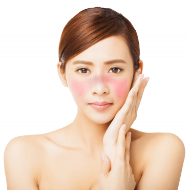 What Is Pigmentation/Melasma?